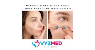 Natural Remedies for Acne: What Works and What Doesn't