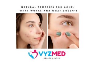 Natural Remedies for Acne: What Works and What Doesn't