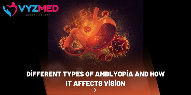 Different Types of Amblyopia and How It Affects Vision