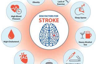 How to Prevent and Treat Stroke